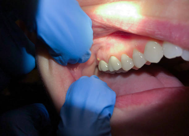 Best Emergency Dental Care for Broken or Chipped Teeth in Cortland, NY